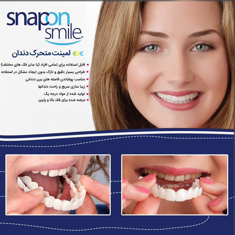 لمینت دندان مدل snap on smile